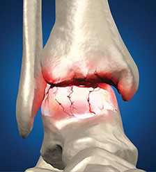 Ankle-Arthritis.jpg